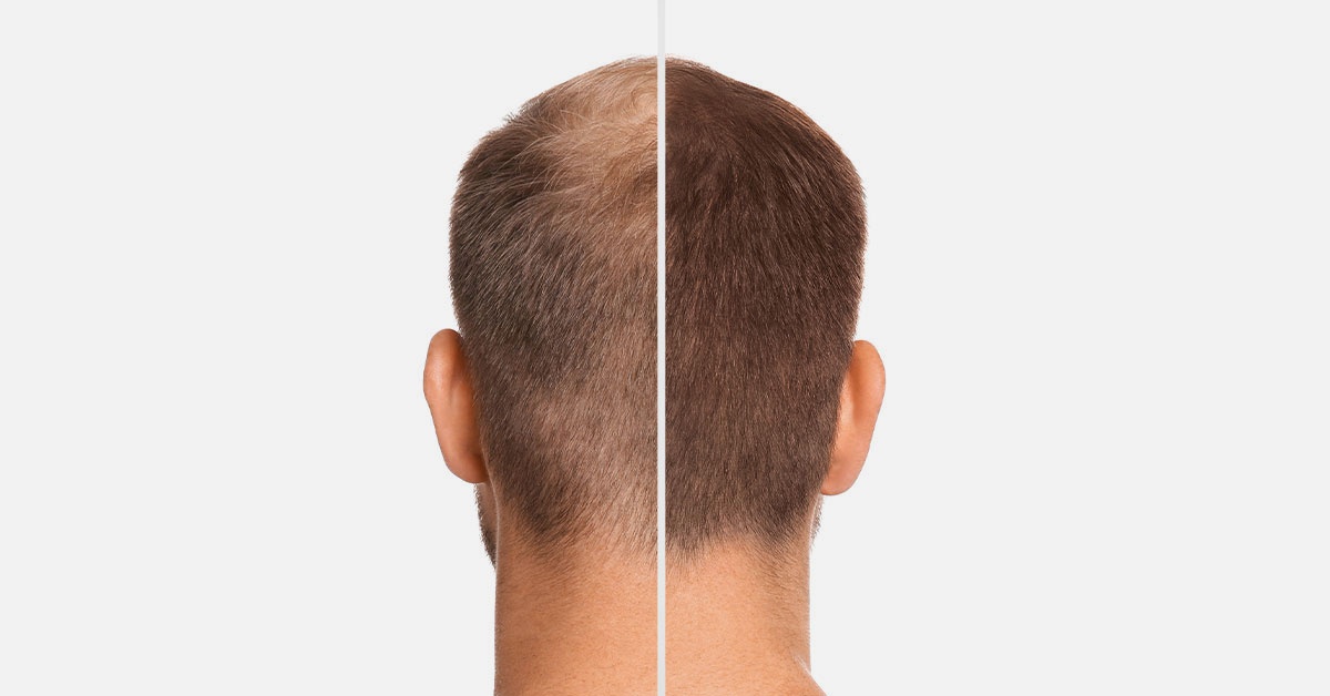 Timeline of Hair Transplant