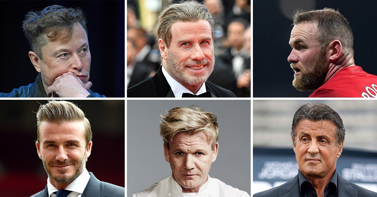 Hair Transplant Celebrities