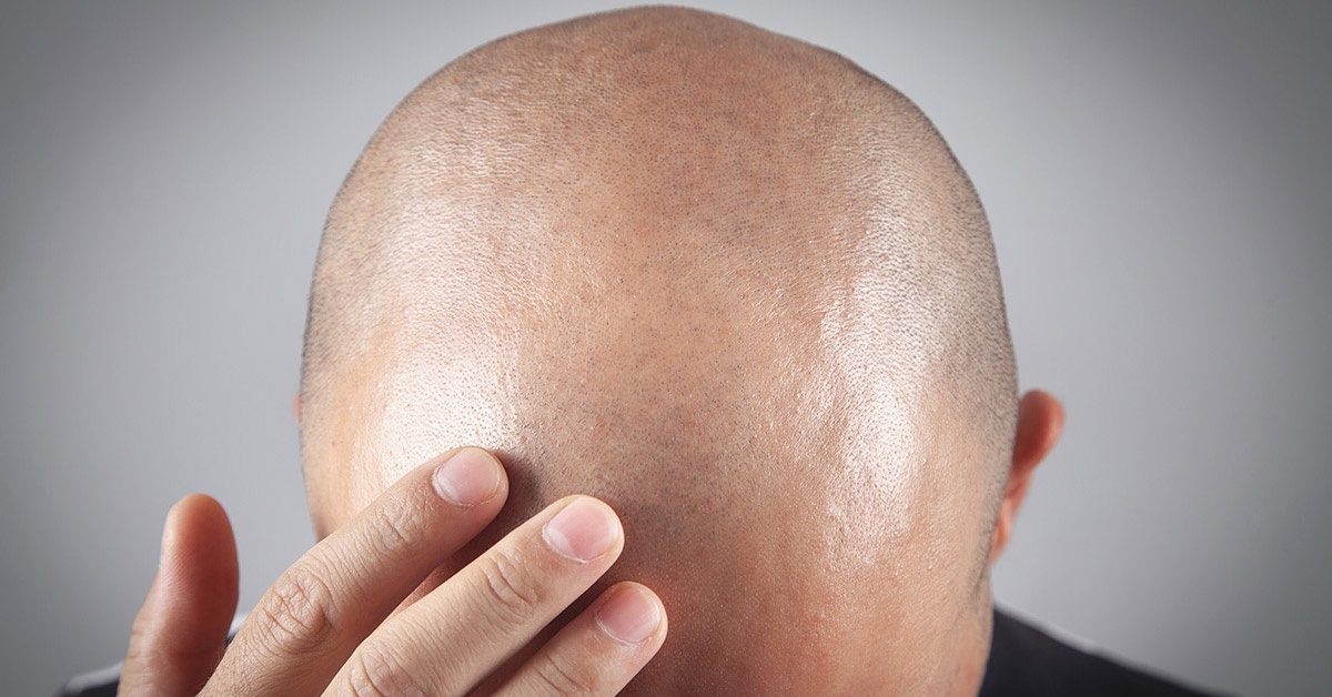 Hair Transplant Cost UK