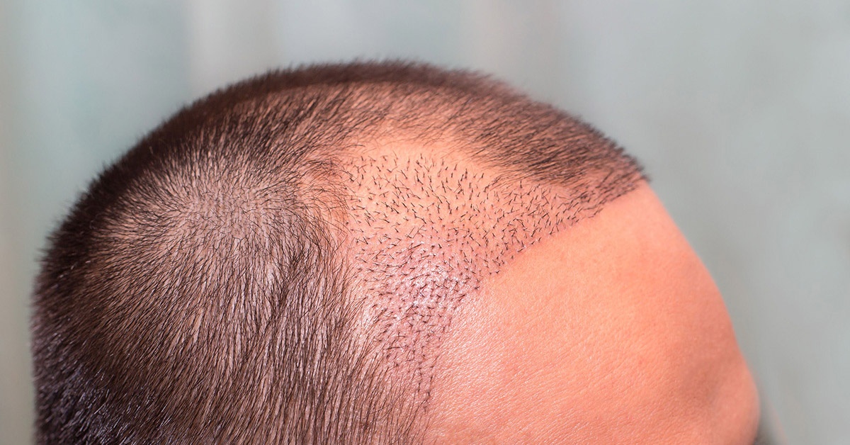 Hair Transplant Cost UK