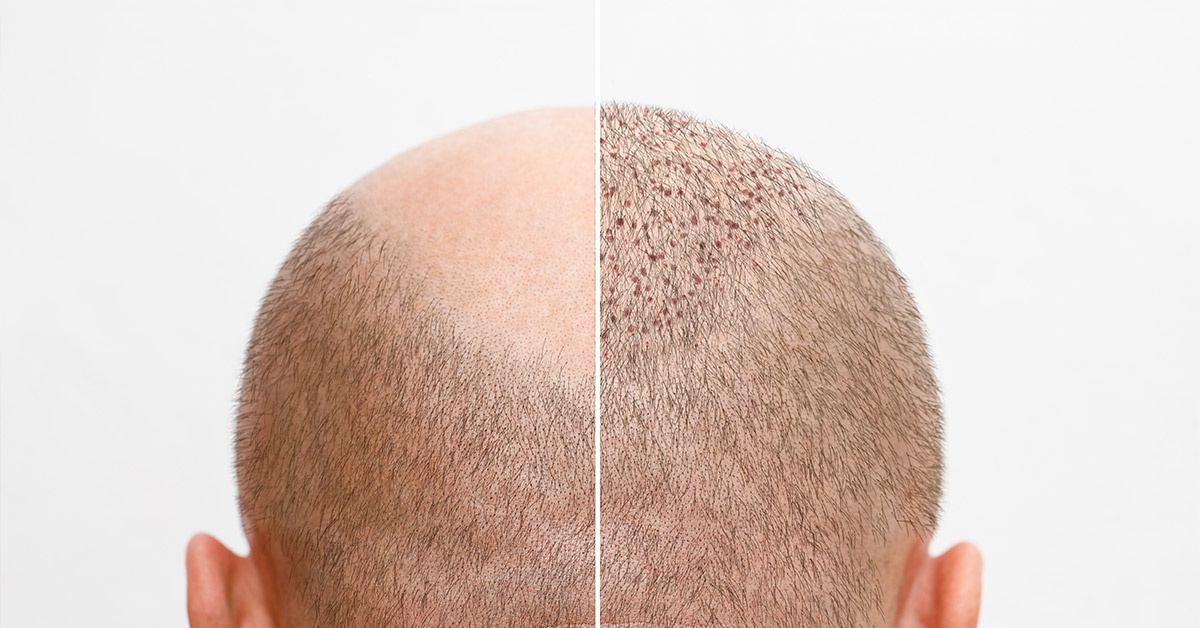 Does Hair Transplant Hurt?