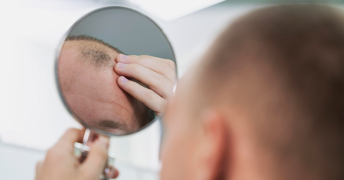 Do Hair Transplants Work?