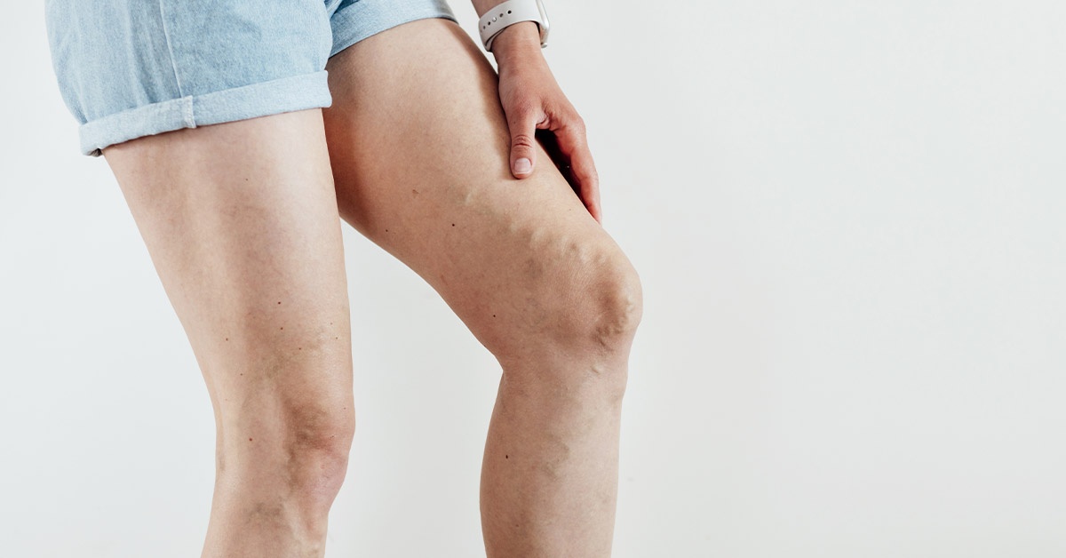 When To Worry About Varicose Veins