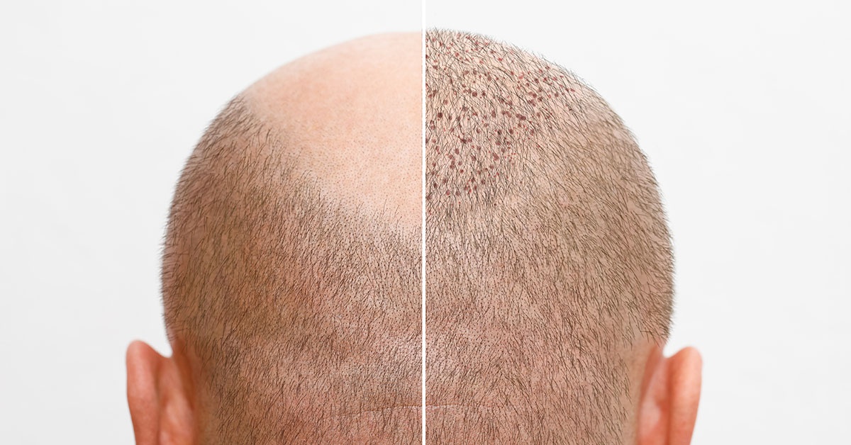 Timeline of Hair Transplant