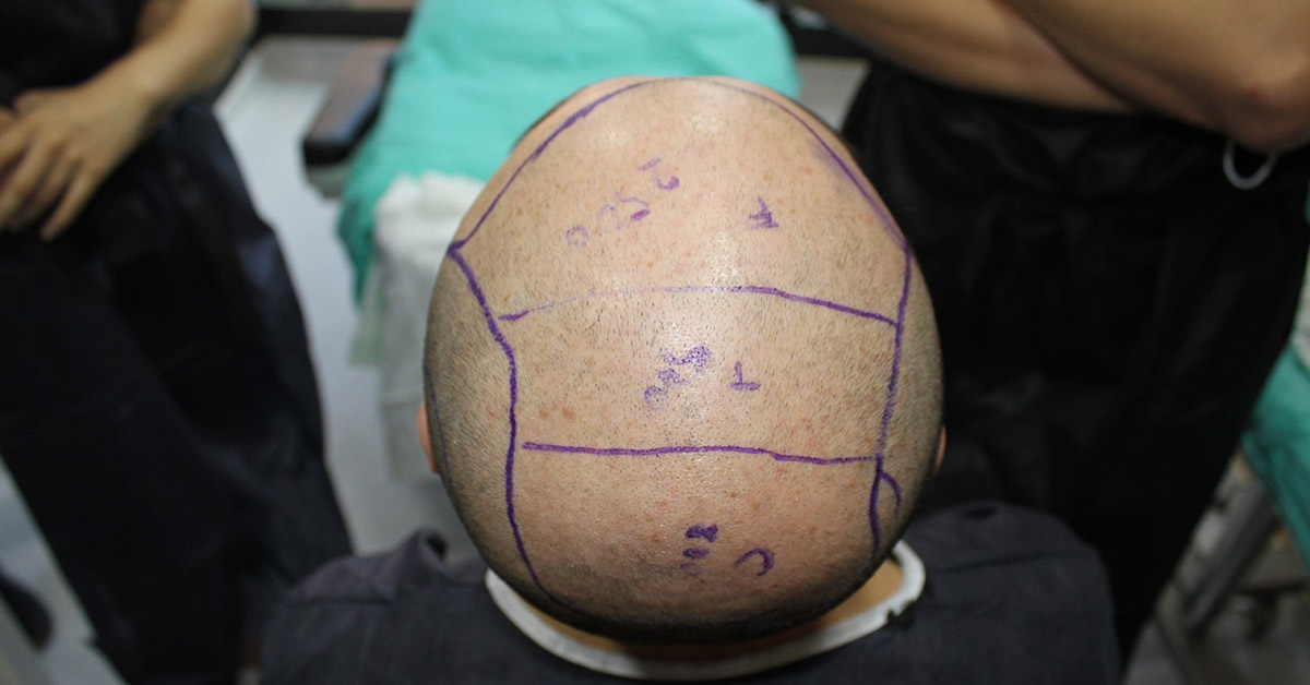 Hair Transplant Cost UK