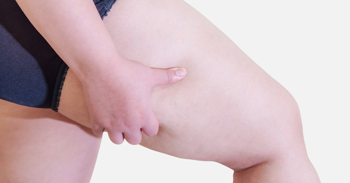 The Painful Fat Disease: Lipedema - Weelunk