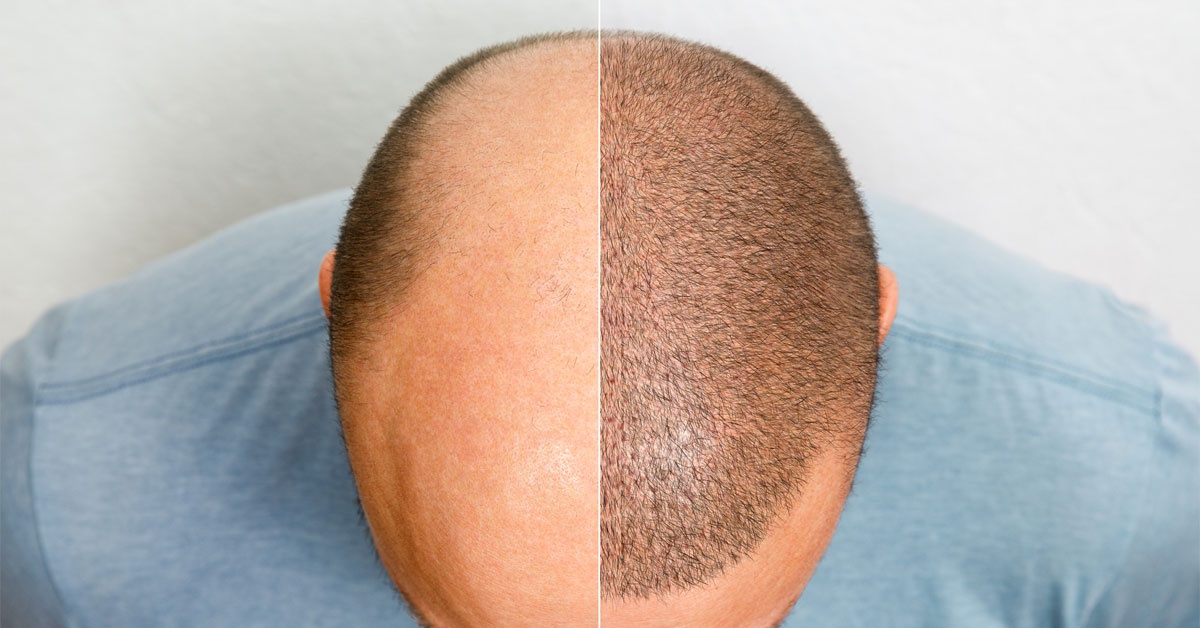 Hair Transplant Results