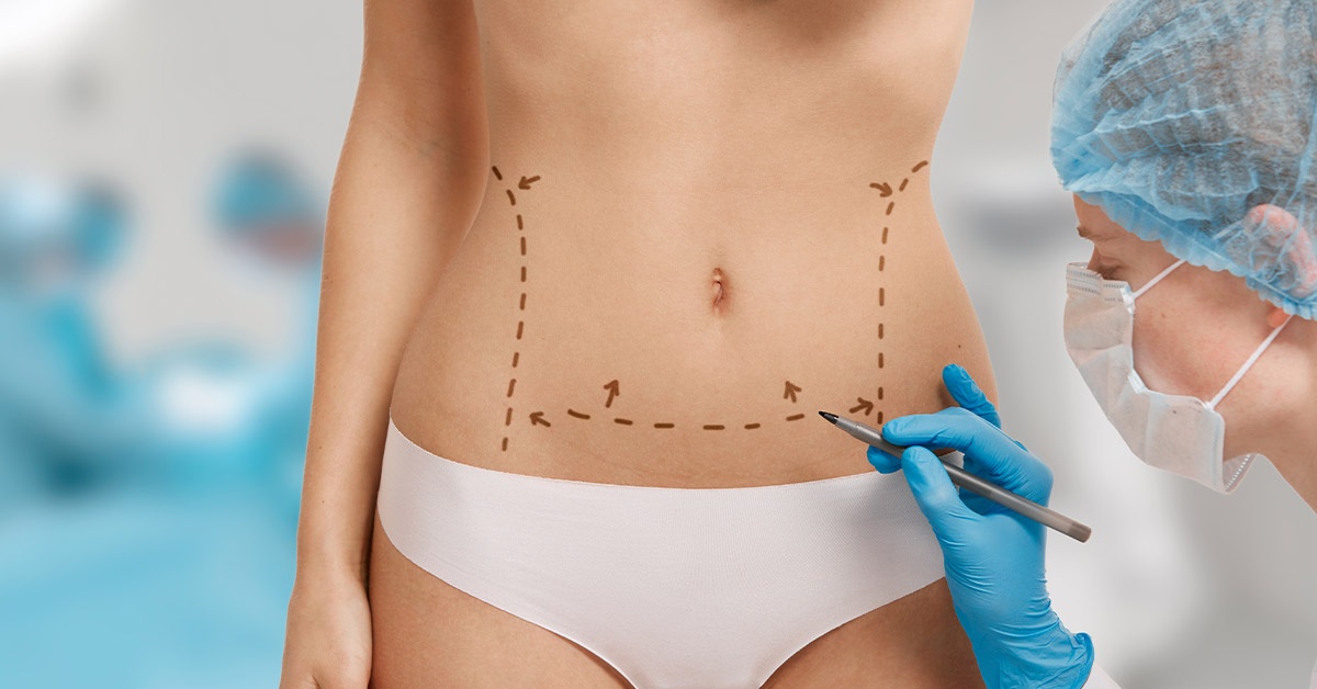 Tummy Tuck Hernia Repair: What You Need To Know - Heights Plastic Surgery