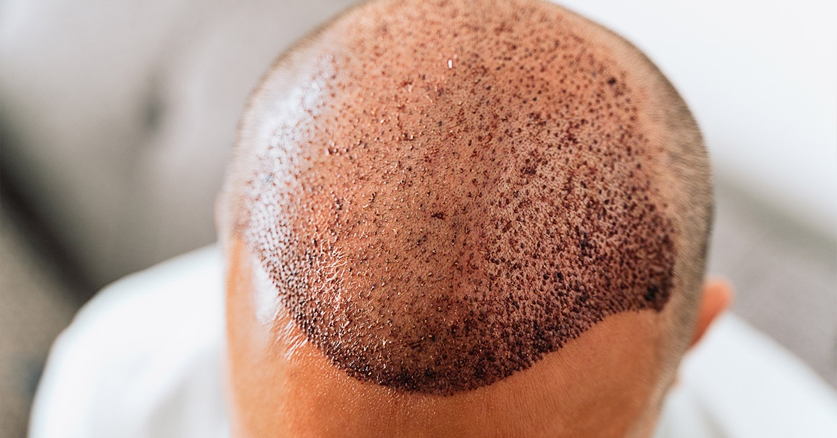 Hair Transplant FUE