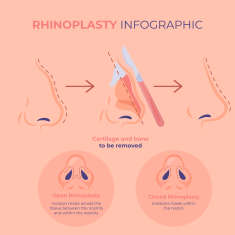 Rhinoplasty Insights on Modern Nose Job Procedures