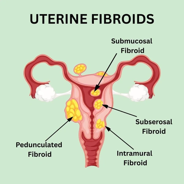 uterus fibroids.webp