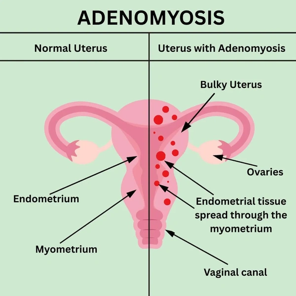 adenomyosis.webp
