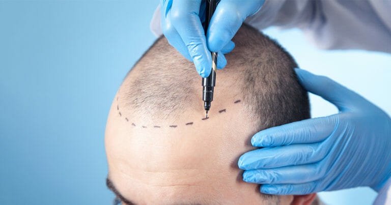 FUE Hair Transplant Cost in Turkey