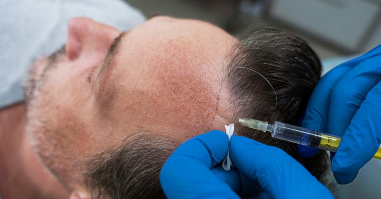 DHI hair transplant costs in Turkey