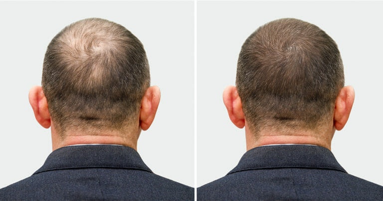 FUT hair transplant costs in Turkey