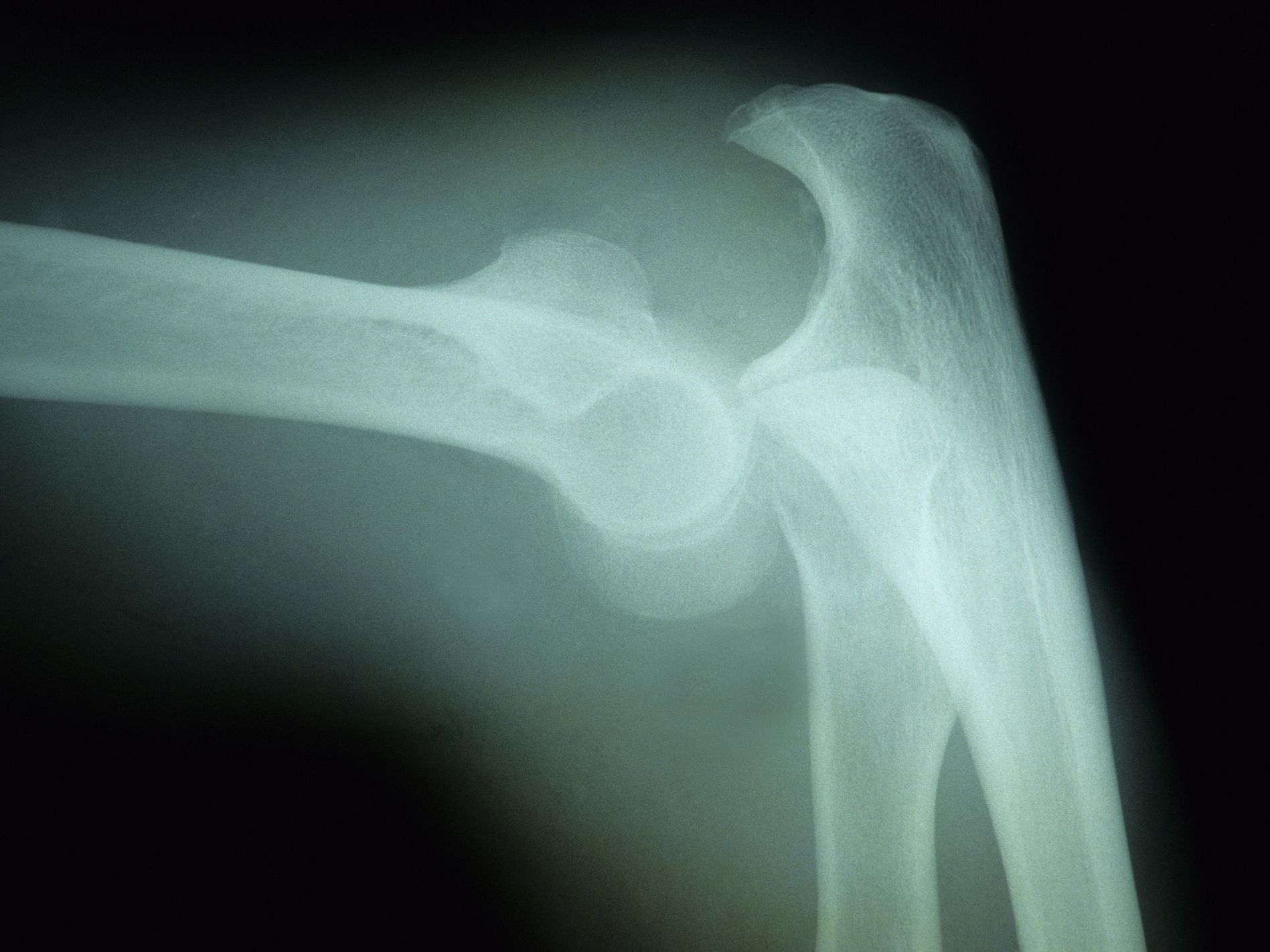 osteoporosis-from-vinegar