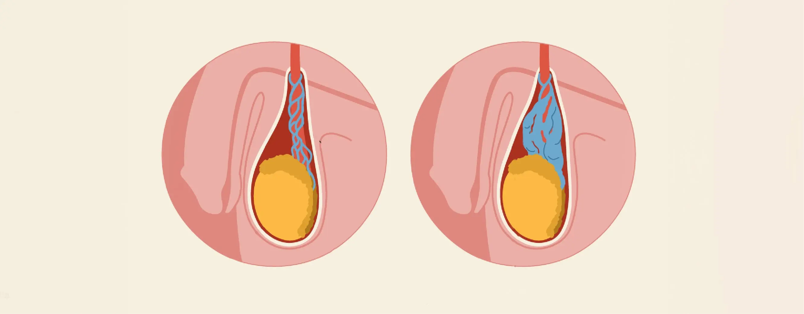 cost-of-varicocele-surgery-in-bangalore