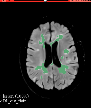 MS-PINPOINT study funded and due to start!