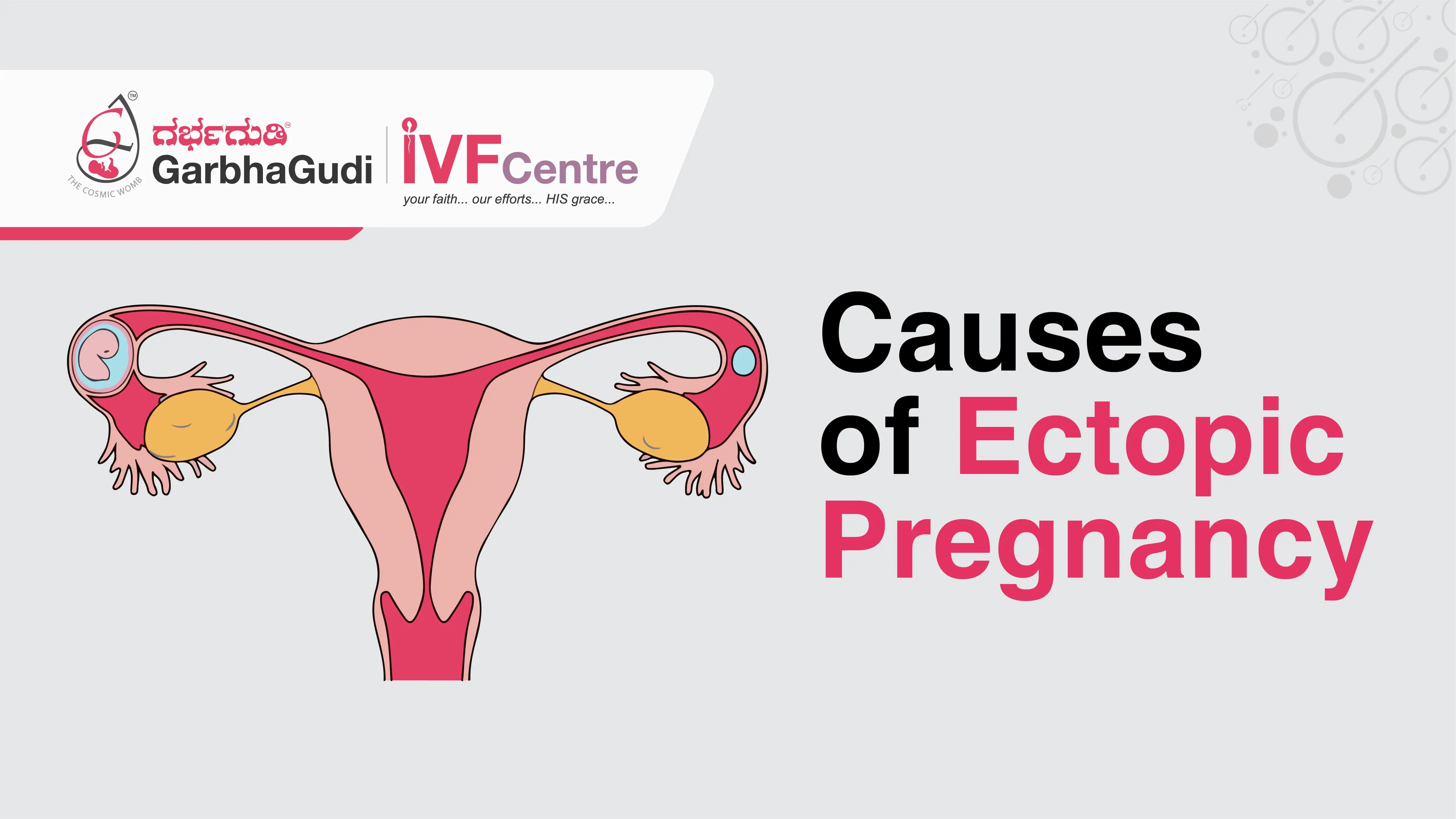 Causes of ectopic pregnancy