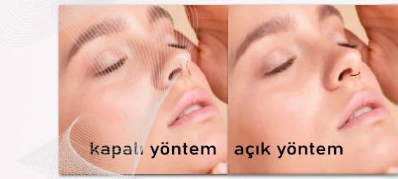 burun_estetiği_açık_kapalı.webp